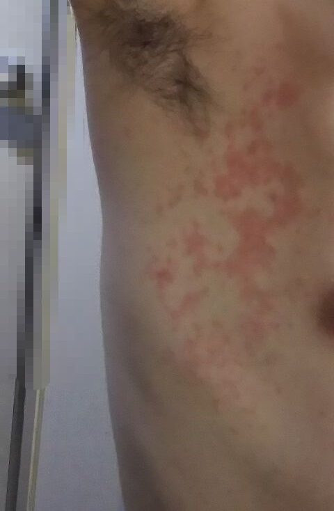 脇の下にびっしりとブツブツ