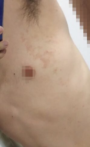 初日の朝に脇の下と二の腕に塗って夕方に鏡で確認２枚目