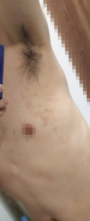 ある日 気が付いたら脇の下周りと 二の腕に湿疹のようなブツブツが広がっていた 痒いし痛いのであの薬を塗ってみたら治ったよ Useful Things For A Life And Alive